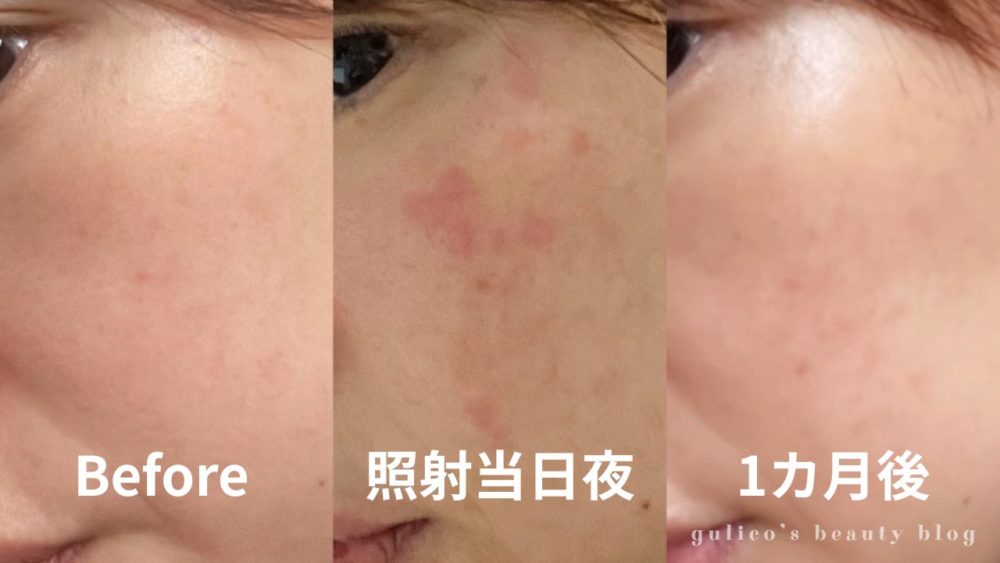 レーザーフェイシャルを受ける前と1ヶ月後の肌の変化